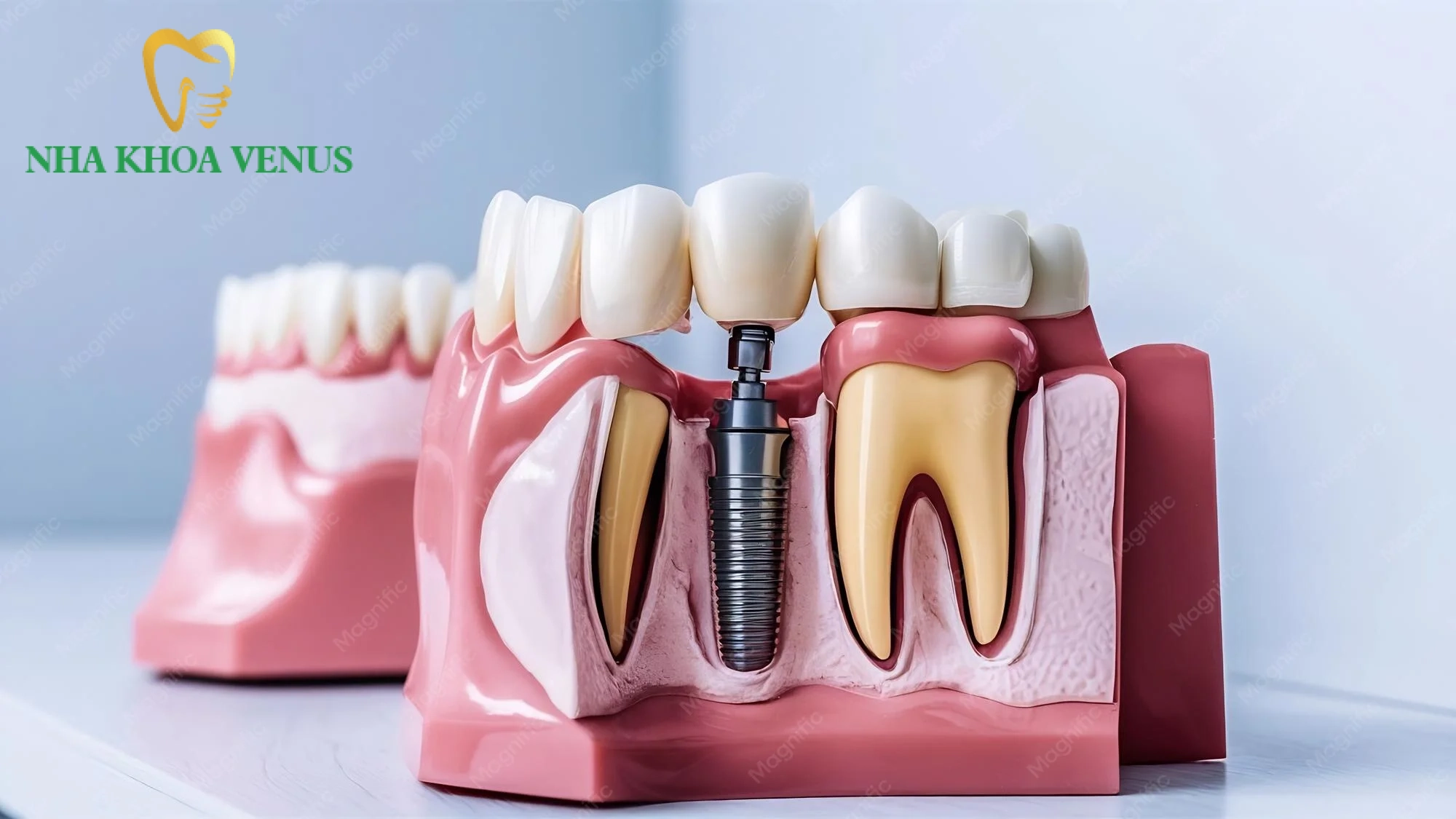 Phục hình răng là gì? Các phương pháp và bảng giá trọn gói 6 Các phương pháp phục hình răng thẩm mỹ phổ biến hiện nay