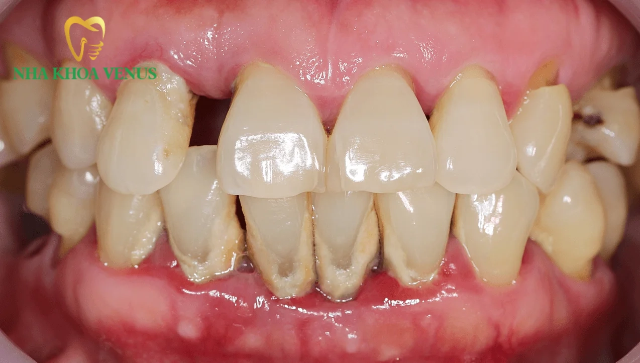 Sưng lợi răng cửa do đâu? Cách điều trị dứt điểm an toàn 8 vôi răng dưới nướu phá hủy dây chằng nha chu gây áp xe sưng lợi răng cửa