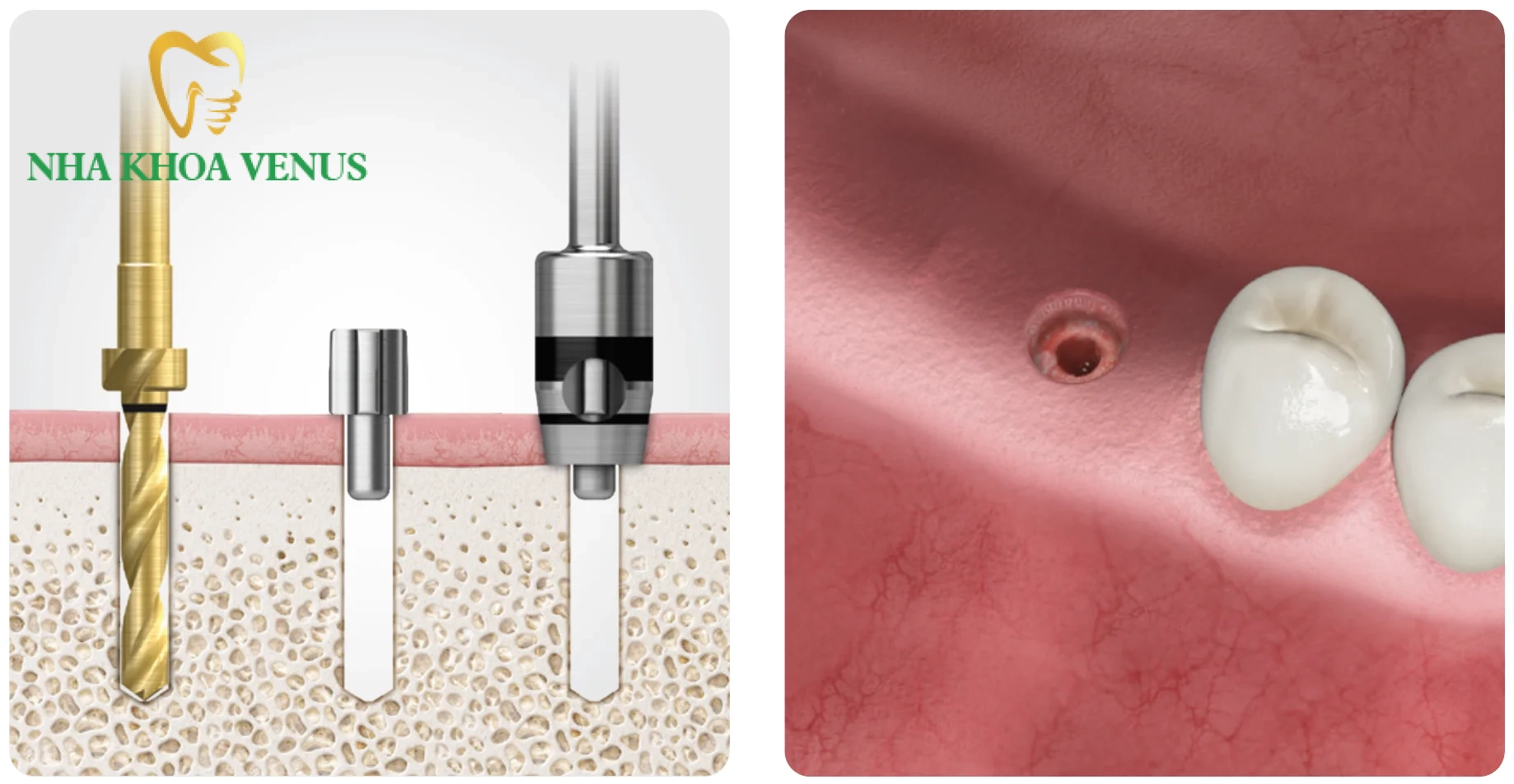 Cấy ghép Implant không phẫu thuật lật vạt là gì?