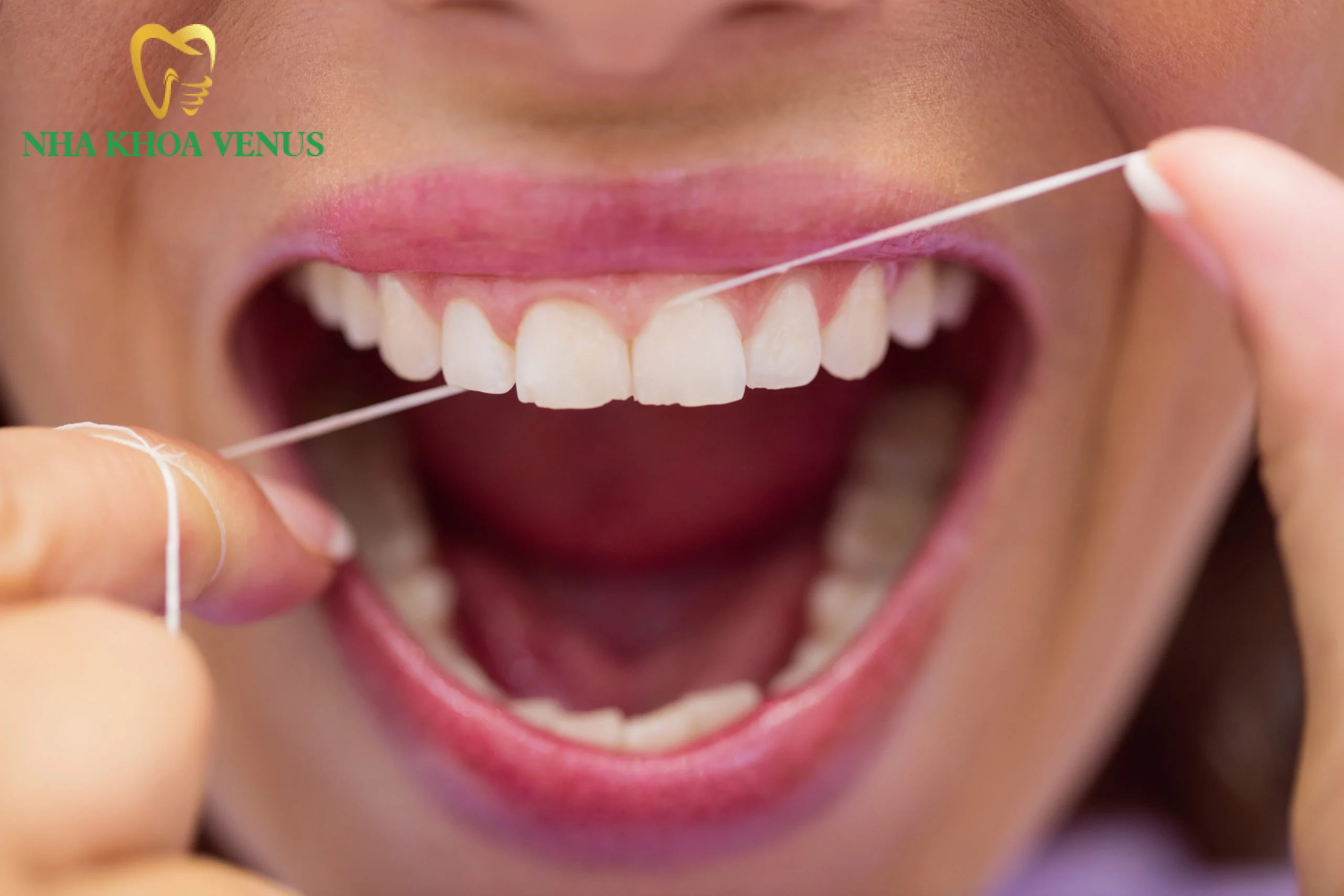 Chăm sóc vệ sinh răng miệng đúng cách sau khi dán sứ Veneer