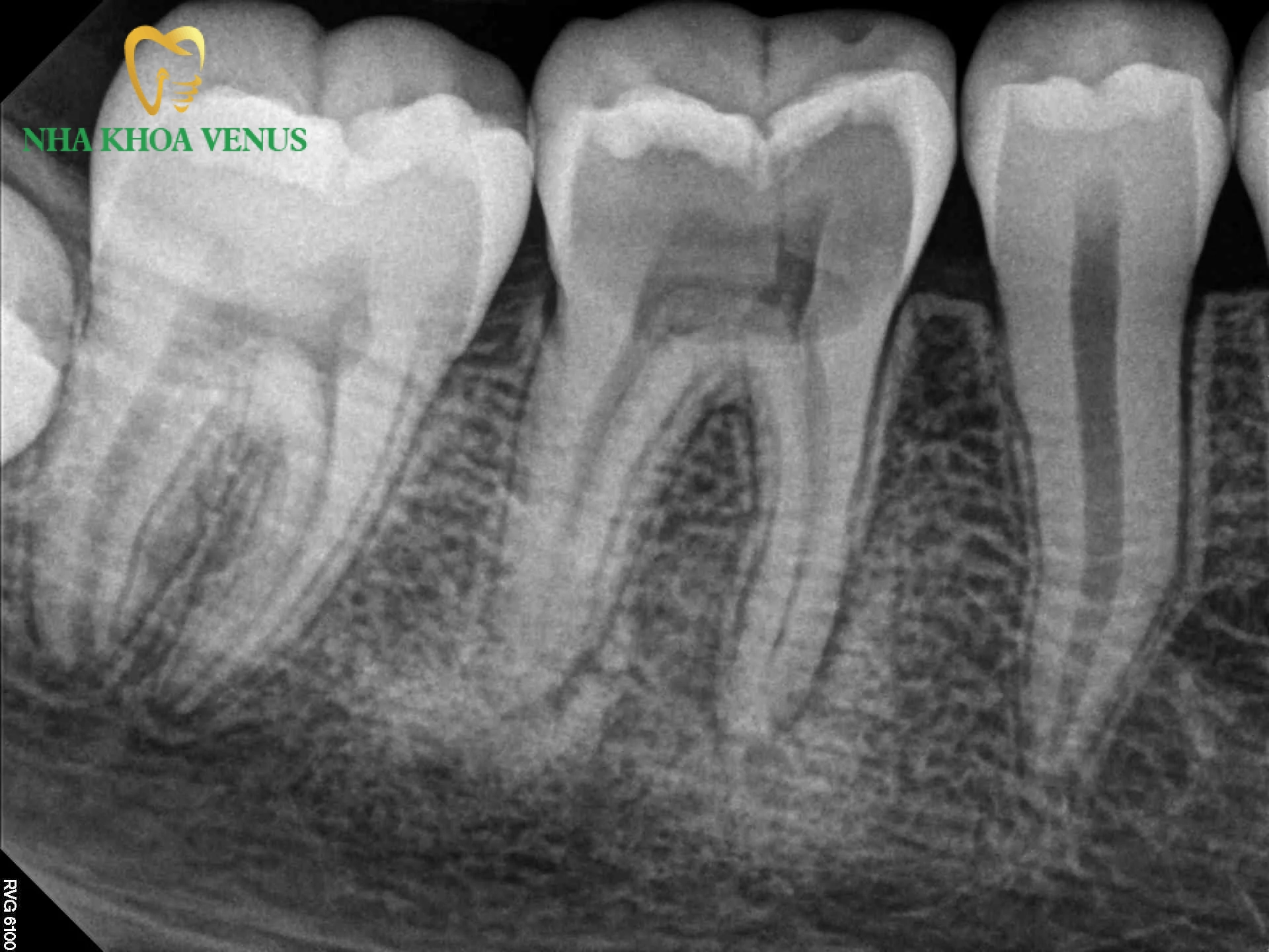 Nhổ răng số 6 có nguy hiểm không? Phác đồ can thiệp chuẩn 7 Các trường hợp bệnh lý bắt buộc phải nhổ bỏ răng số 6