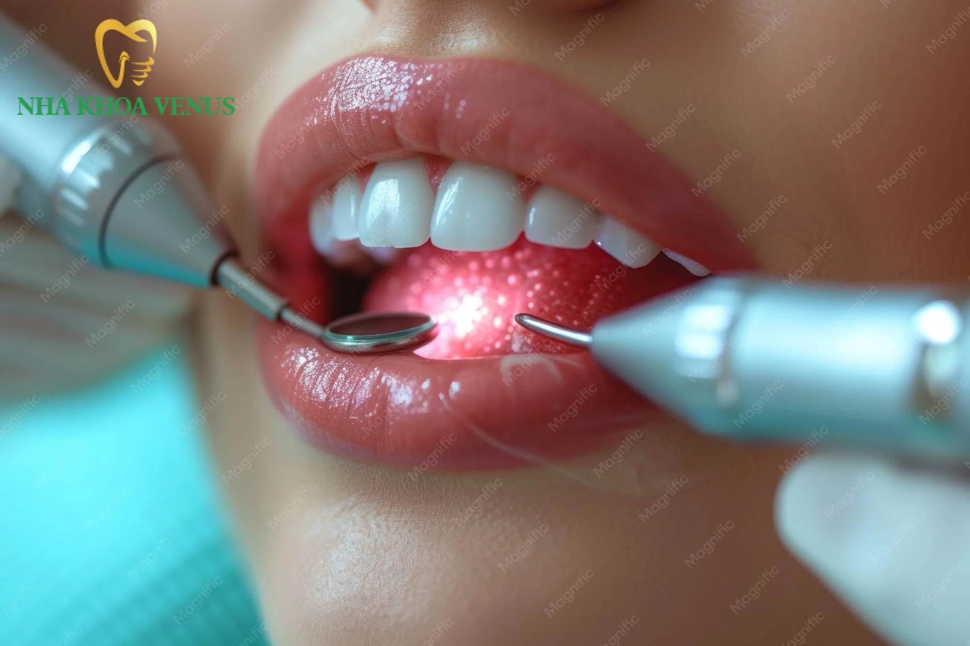 Sưng lợi răng cửa do đâu? Cách điều trị dứt điểm an toàn 9 điều trị sưng lợi răng cửa triệt để bằng công nghệ lấy cao răng siêu âm không đau