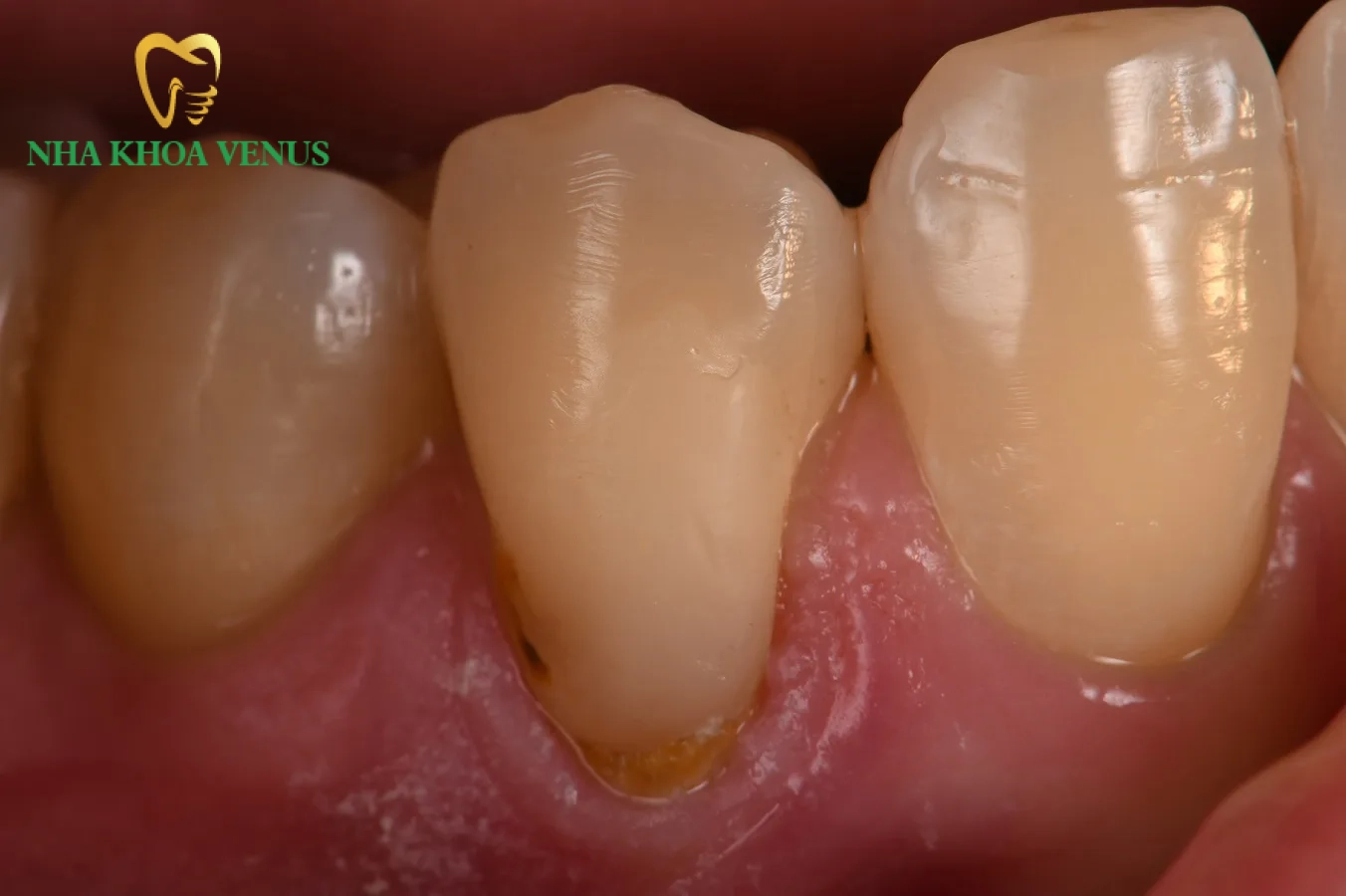 hình ảnh răng bị lộ ngà ở vùng cổ chân răng gây ê buốt nhói