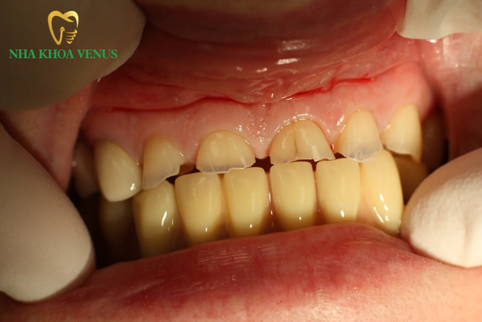 hình ảnh răng bị lộ ngà ở vùng cổ chân răng gây ê buốt nhói