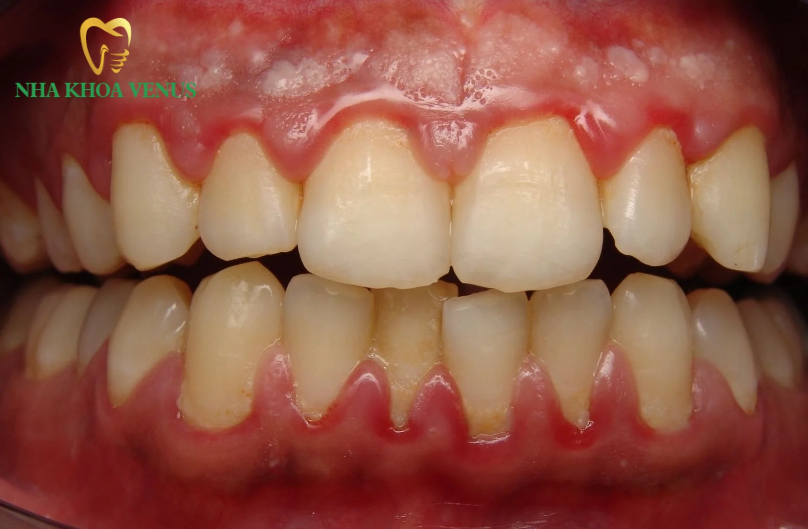 Nha khoa Venus 140 Hình ảnh tình trạng sưng lợi răng cửa đỏ tấy sưng phồng do viêm nướu tích tụ mảng bám