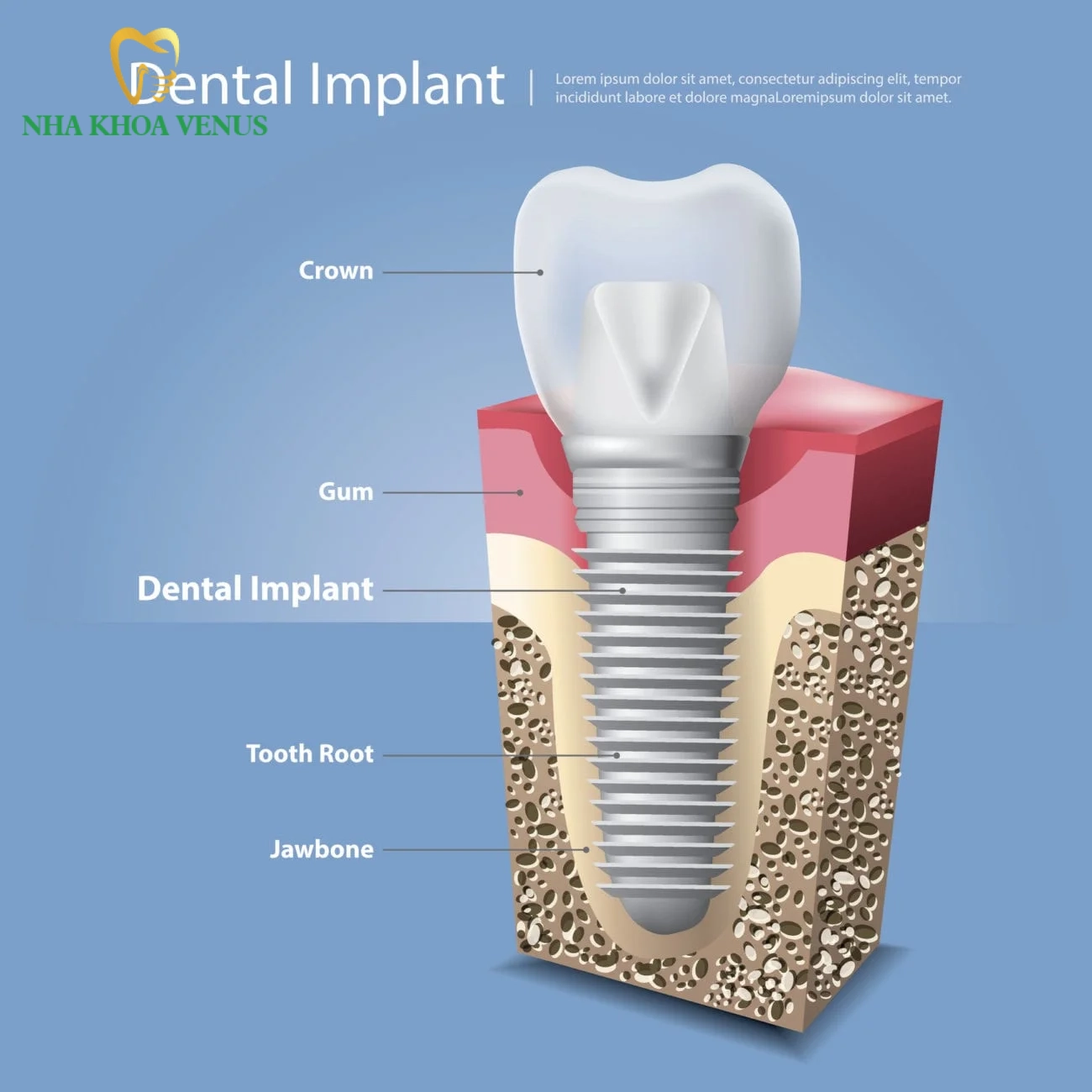 Nha khoa Venus 143 implant chan buom zygomatic la gi uu diem va bang gia nha khoa venus nha khoa venus