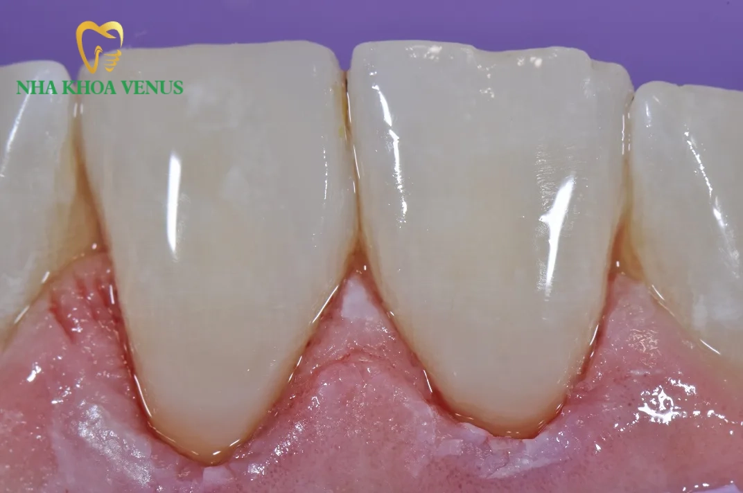 Chữa răng bị lộ ngà nguyên nhân và cách trị dứt điểm 10 kết quả phục hồi răng lộ ngà cổ chân răng hết ê buốt nụ cười khỏe đẹp