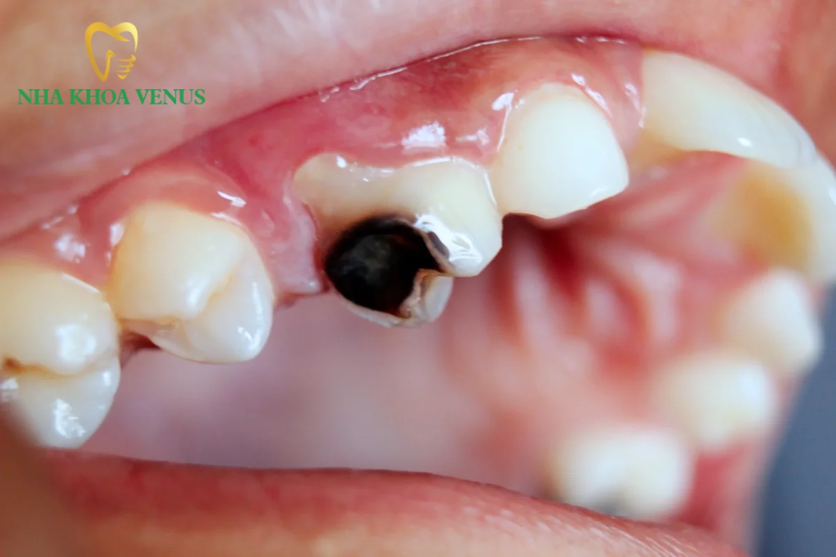 Trị sâu răng tại nhà bằng muối có thật sự khỏi và an toàn? 7 Hình ảnh lỗ sâu răng thực tế phá hủy men răng và ăn sâu vào lớp ngà
