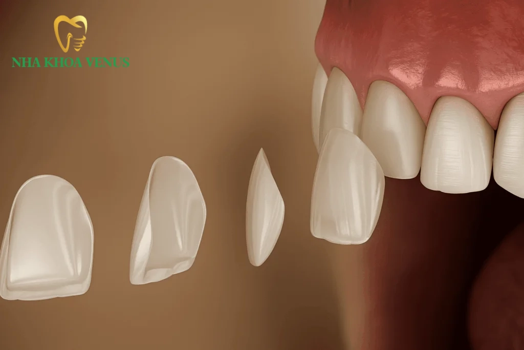Dán sứ Veneer Emax là gì? Ưu điểm, độ bền và bảng giá 2026 4 Mặt dán sứ Veneer Emax siêu mỏng chuẩn tỉ lệ khớp cắn