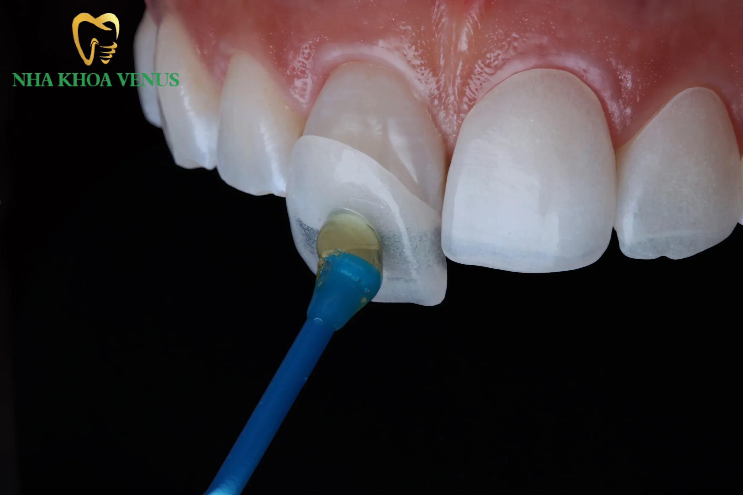 Răng nhiễm fluor là gì? Dấu hiệu và cách tẩy trắng hiệu quả 4 Những rủi ro y khoa khi dán sứ Veneer trong thai kỳ