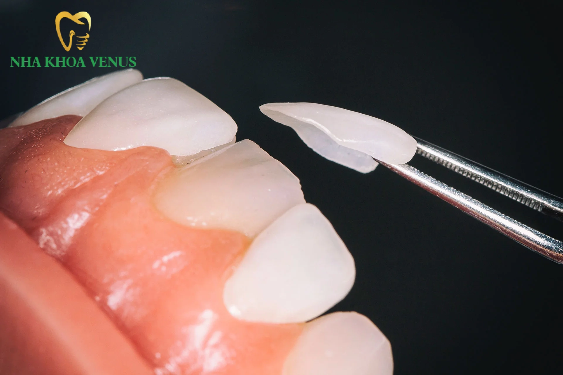 Mặt dán sứ Veneer siêu mỏng bảo tồn men răng tự nhiên