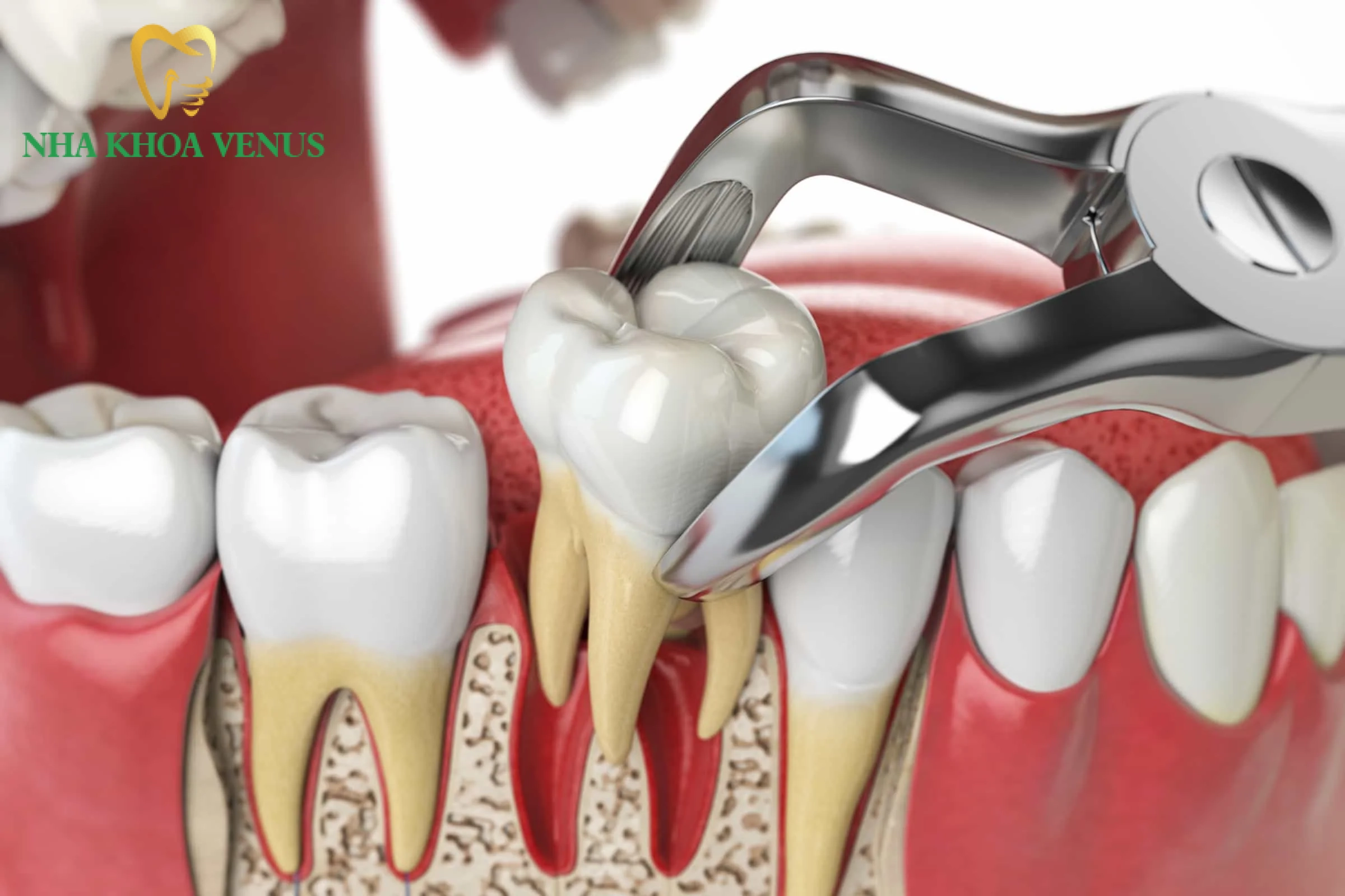 Nhổ răng số 6 an toàn chuẩn y khoa không đau nhức