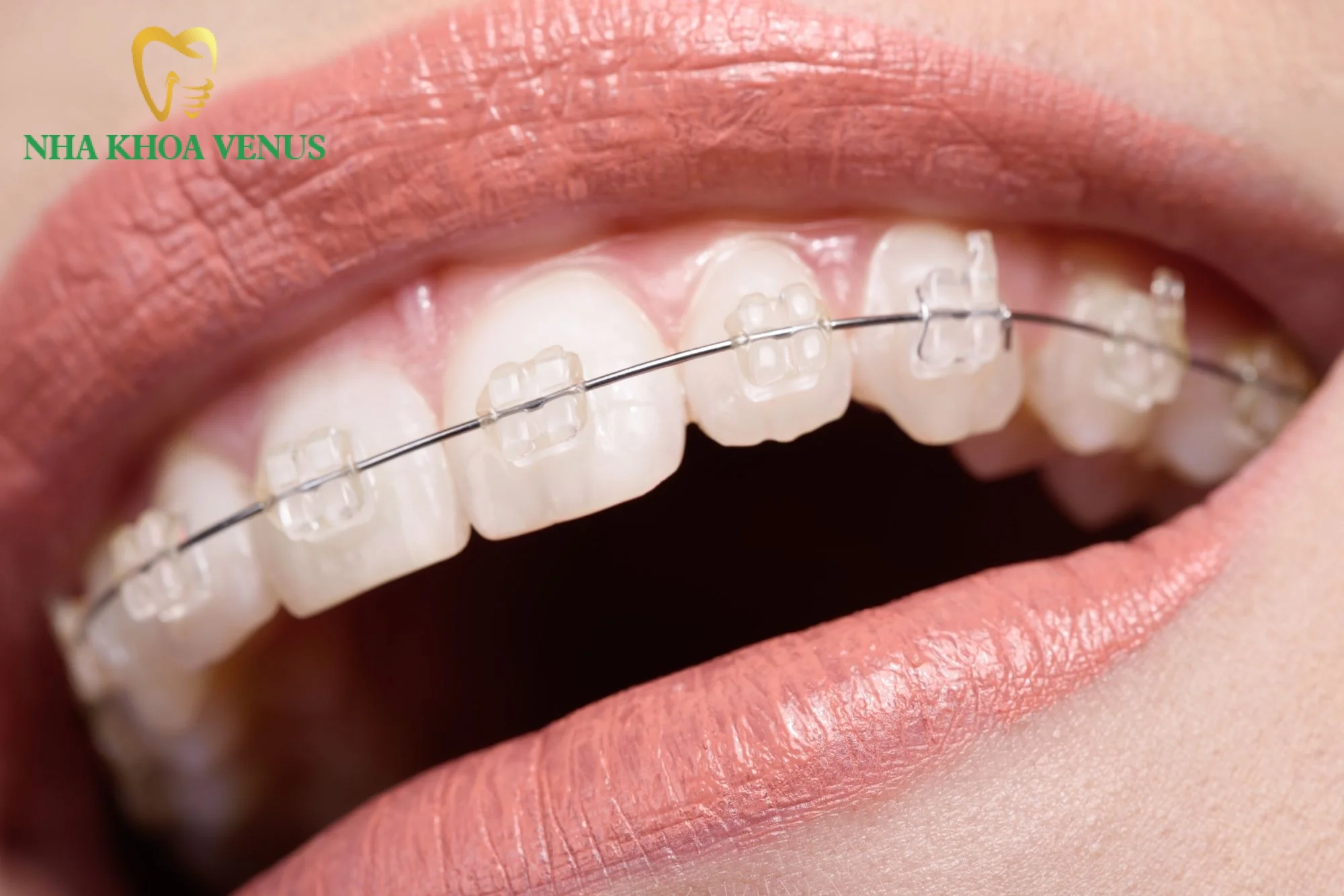 Niềng răng chỉnh nha điều trị lệch khớp cắn hiệu quả