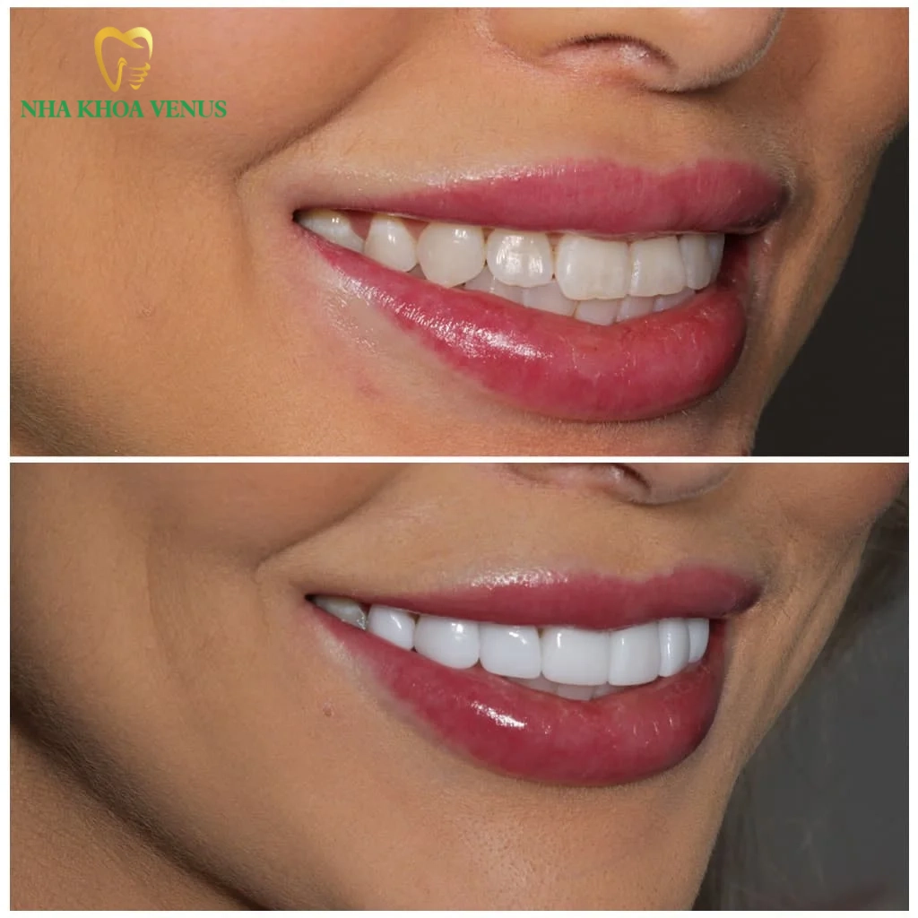 Đang mang thai có nên dán sứ Veneer không? 7 Nụ cười trắng sáng tự nhiên sau khi dán sứ Veneer an toàn sau sinh