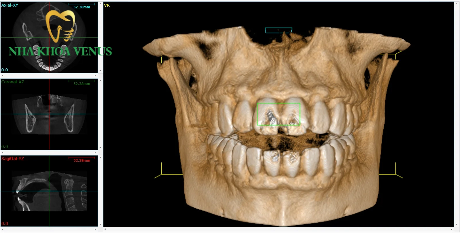 Bệnh tiểu đường có trồng răng được không? 6 Phim chụp CT Cone Beam 3D khảo sát mật độ xương hàm trước khi cấy ghép Implant