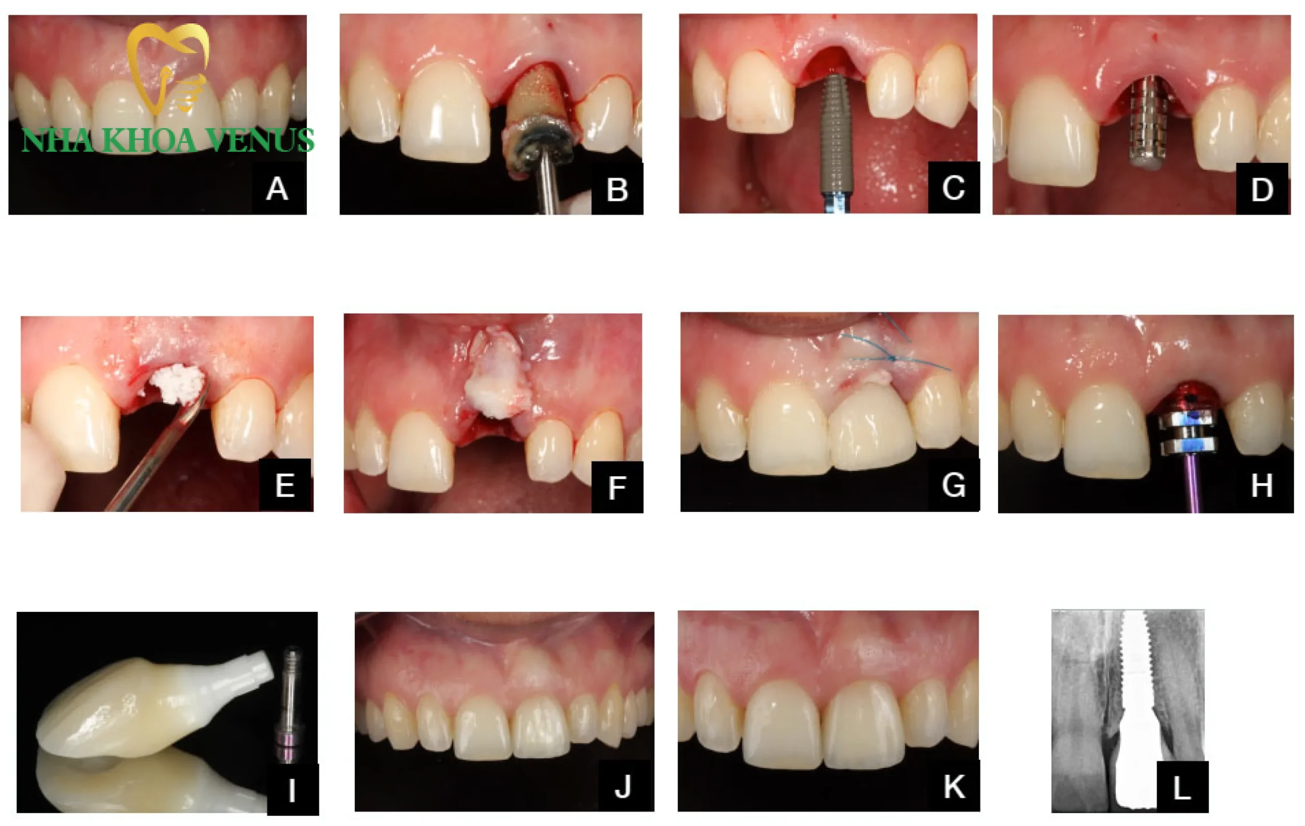 Cấy ghép Implant không phẫu thuật lật vạt ưu điểm và giá 6 Phục hồi thẩm mỹ tự nhiên và bảo tồn nguyên vẹn gai nướu trong cấy ghép Implant không lật vạt