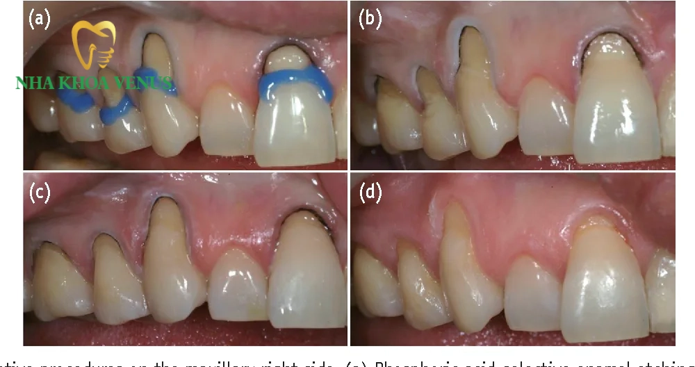 Chữa răng bị lộ ngà nguyên nhân và cách trị dứt điểm 9 quy trình trám composite phục hồi cổ răng bị lộ ngà chuẩn y khoa