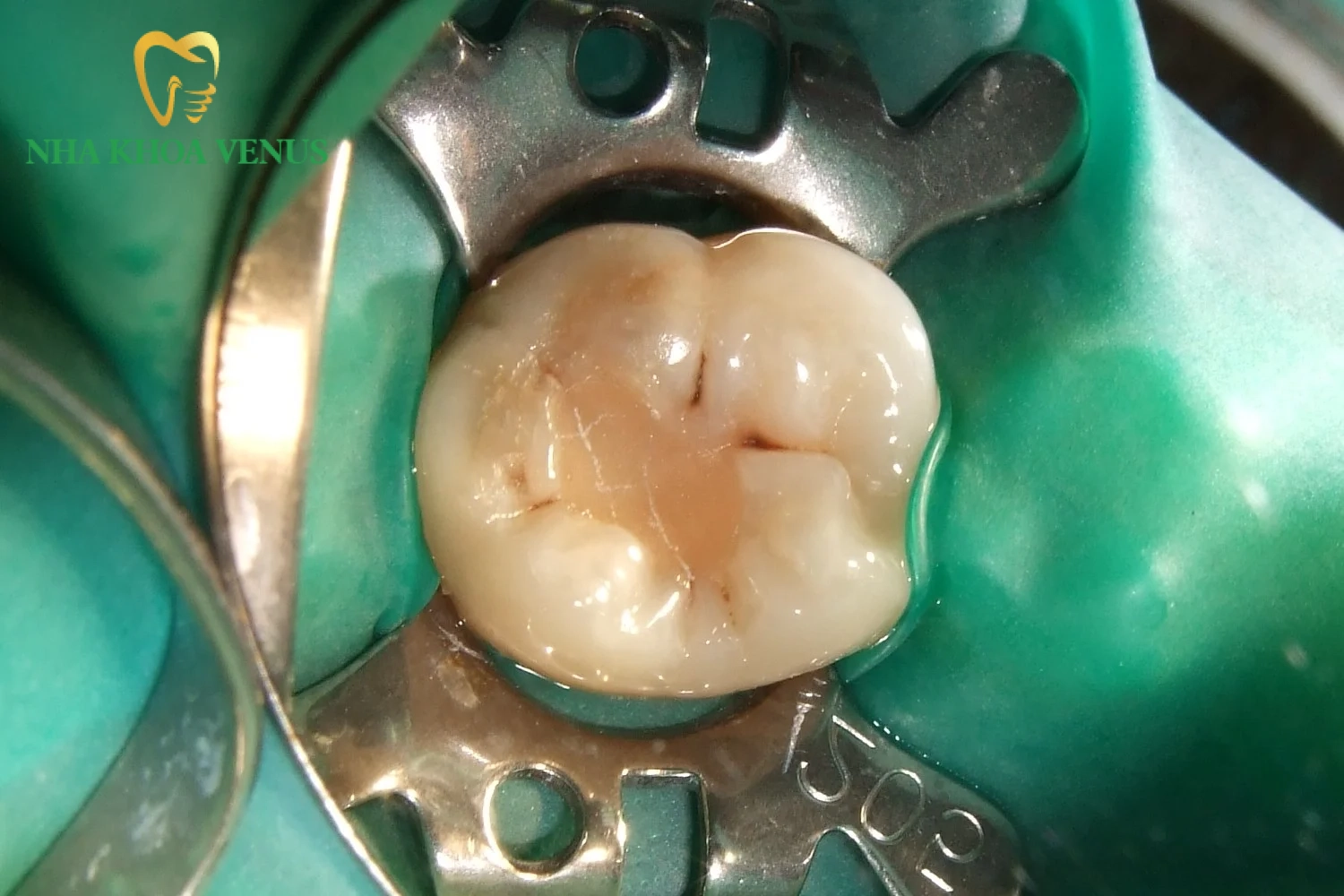 Chữa răng bị lộ ngà: Dấu hiệu, nguyên nhân và cách điều trị 7 bác sĩ thực hiện trám răng composite che phủ vùng ngà răng bị lộ