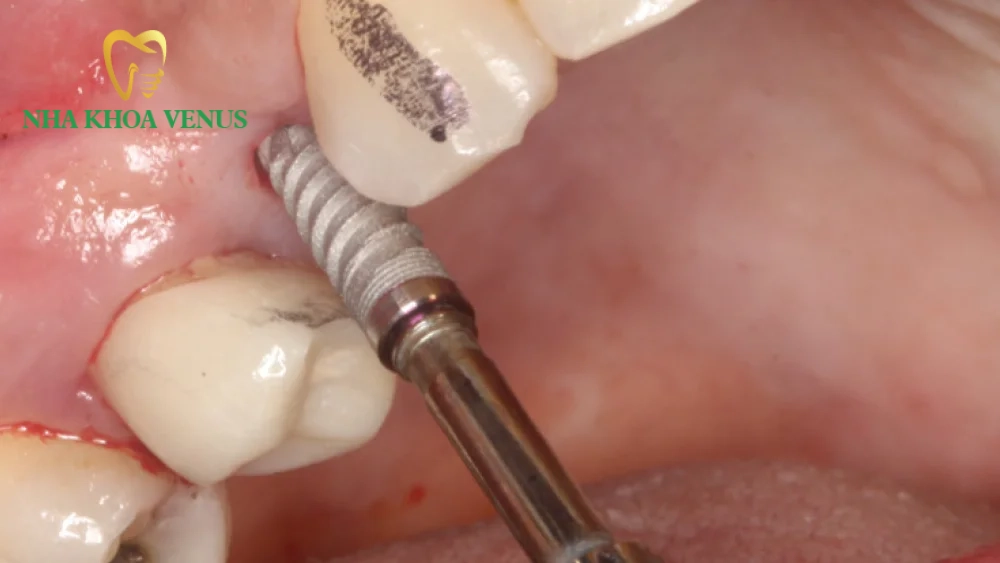 Hối hận vì trồng Implant giá rẻ cảnh báo biến chứng 2026 5 Ưu điểm của phương pháp cấy Implant không lật vạt