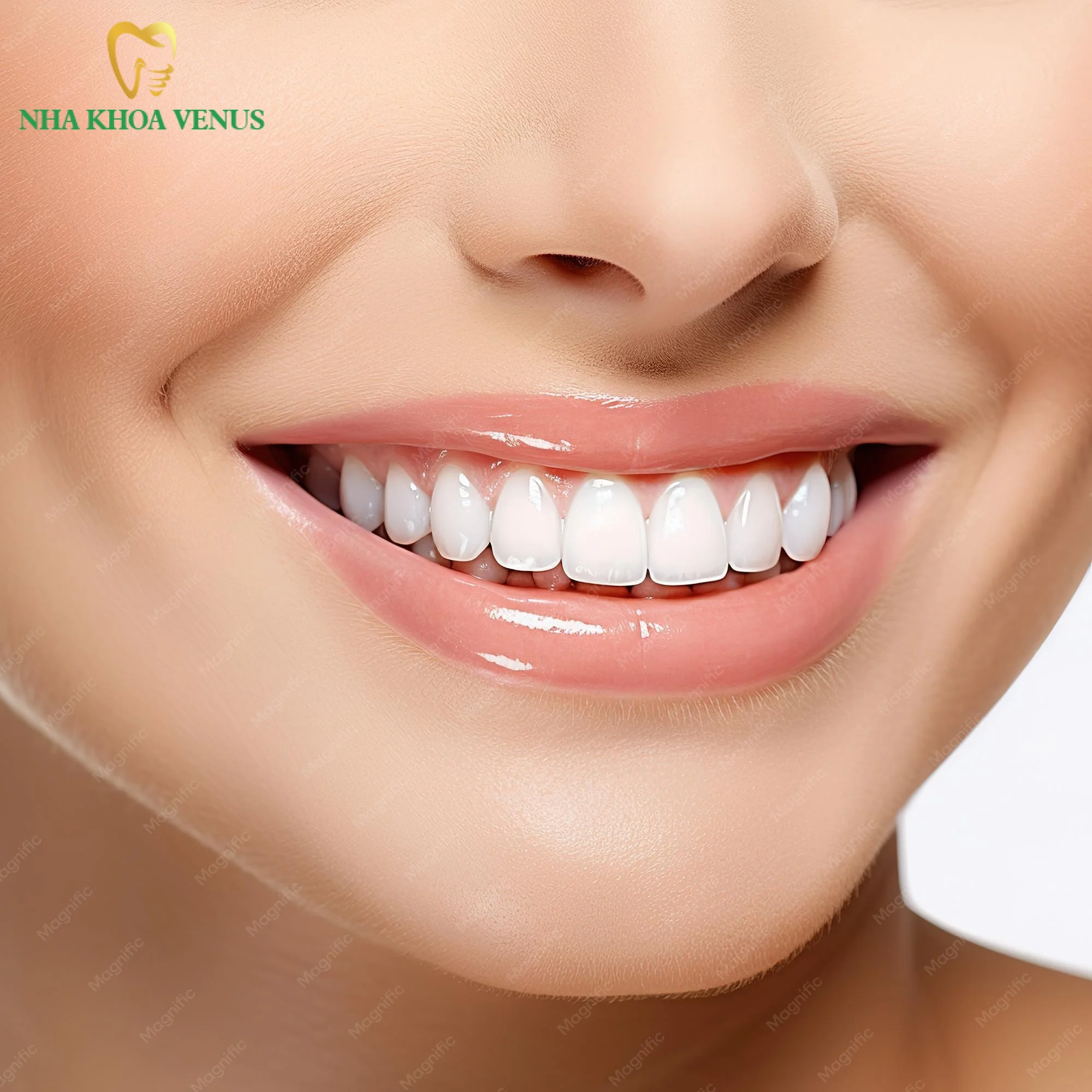 Thiết kế nụ cười chuẩn tỉ lệ vàng cân đối giữa cung răng bờ môi và khóe mắt