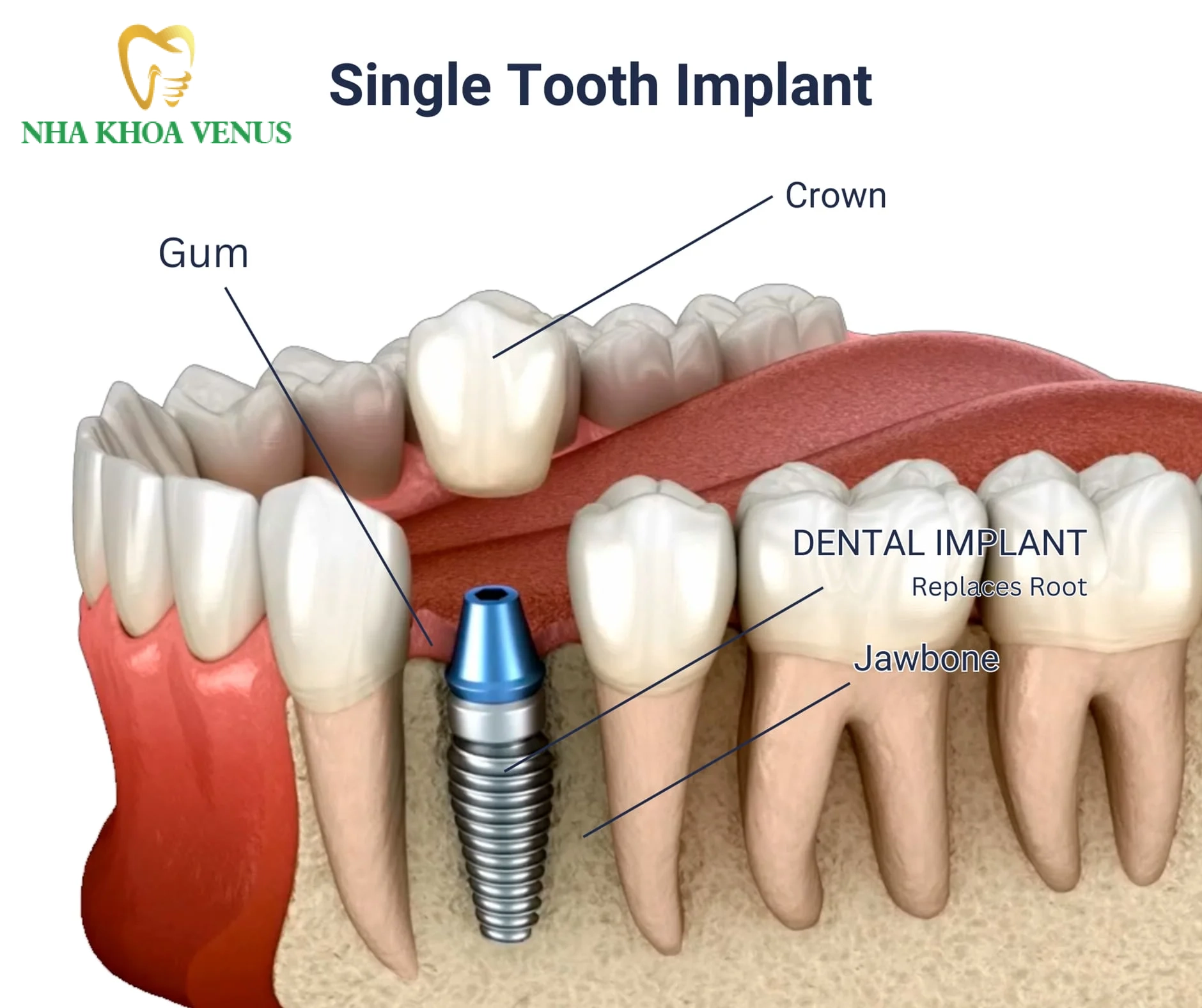 Hối hận vì trồng Implant giá rẻ cảnh báo biến chứng 2026 6 Trồng răng Implant phục hồi răng số 6 ngăn ngừa tiêu xương hàm