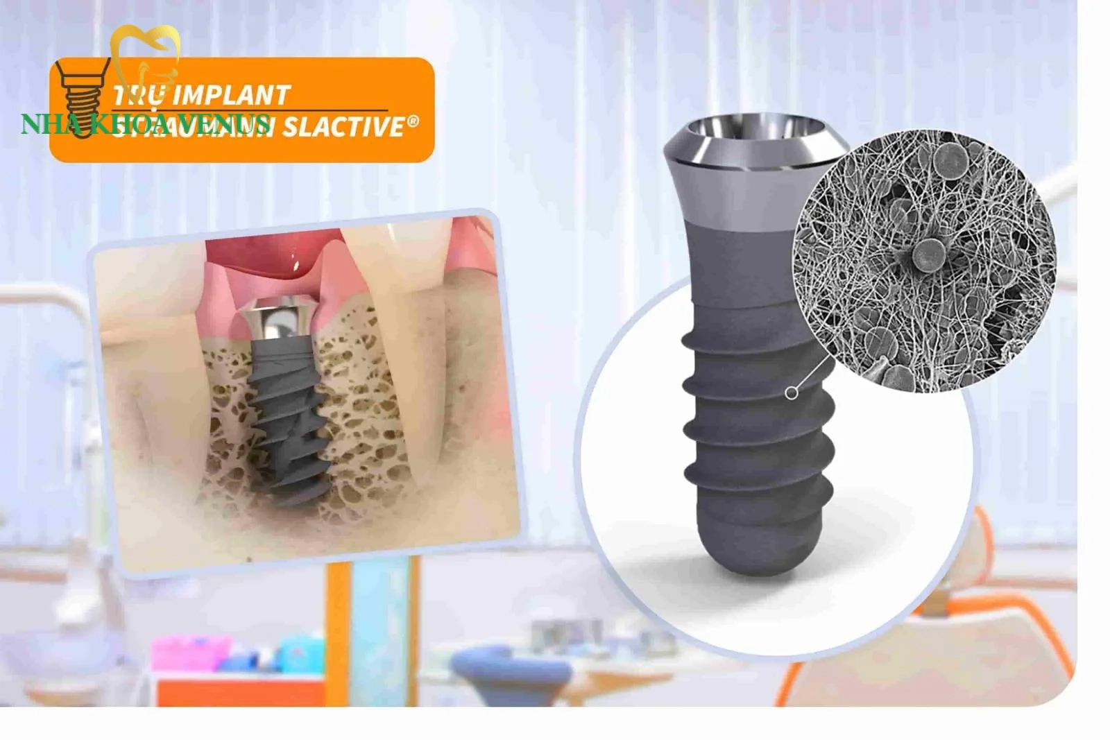 Bệnh tiểu đường có trồng răng được không? 7 Dòng trụ Implant Straumann SLActive bề mặt ưa nước kích thích tích hợp xương nhanh