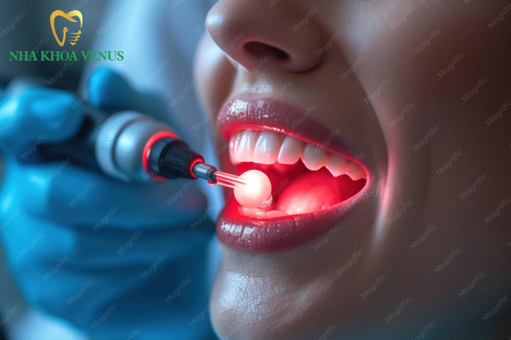 Thủ thuật lấy cao răng siêu âm và đánh bóng men răng định kỳ trong gói khám nha khoa tổng quát