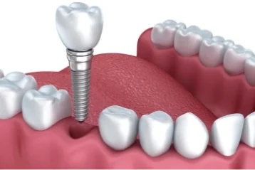 Dịch vụ cấy ghép implant