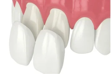 Dịch vụ dán sứ Veneer