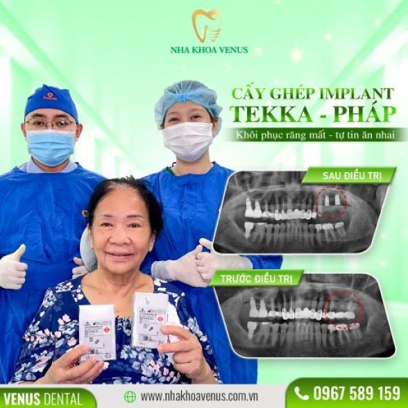 ket-qua-cay-ghep-implant-tai-nha-khoa-venus-5