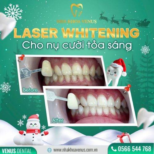 kết quả tẩy trắng răng tại nha khoa venus